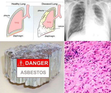 asbestos-fiber-exposure-levels-and-lung-cancer-mortality-by-thor-anderson